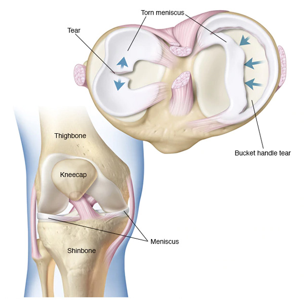 Torn meniscus